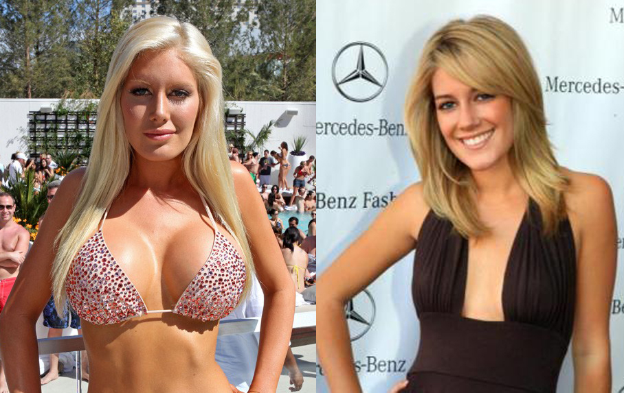 heidi montag surgery before after. heidi montag surgery before